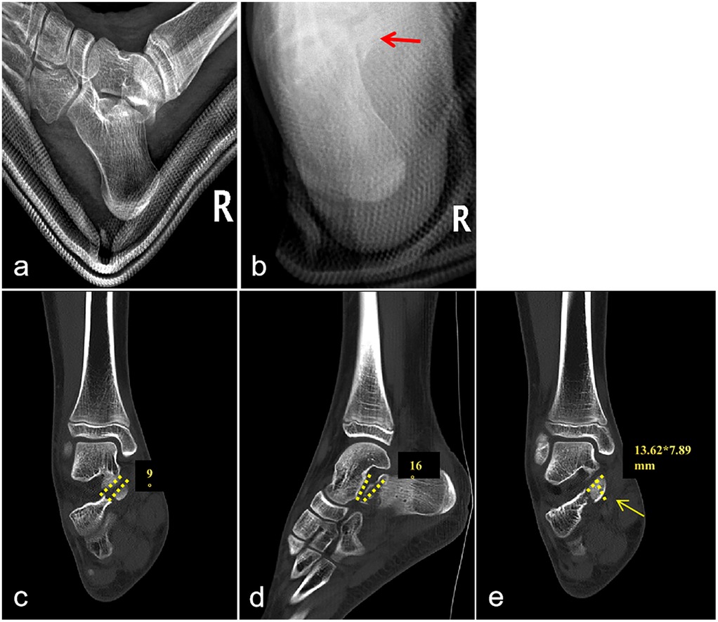 Five-panel X-ray images of a foot, labeled a to e. Panel a and b show different angles of the foot skeleton, with a red arrow highlighting an area in b. Panels c to e display side views, with yellow dashed lines and numerical measurements indicating specific areas, including a measurement of 13.62 by 7.89 millimeters in panel e.