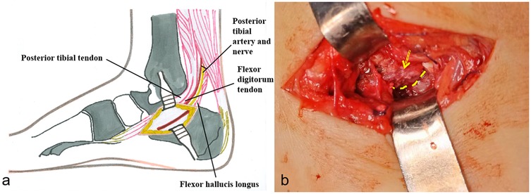 Illustration a shows a cross-sectional view of an ankle highlighting the posterior tibial tendon, posterior tibial artery and nerve, flexor digitorum tendon, and flexor hallucis longus. Photo b depicts a surgical view of an ankle with retractors exposing anatomical structures, with arrows indicating specific anatomic structure.