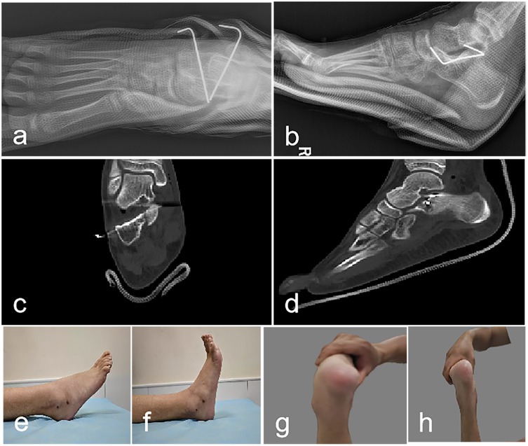 X-rays and CT scans of a foot showing surgical metal implants: Image a displays a top-down X-ray view, while image b provides a side view. Image c shows a transverse CT scan, and image d offers a sagittal CT view. Images e and f depict a ankle joint range of motion.