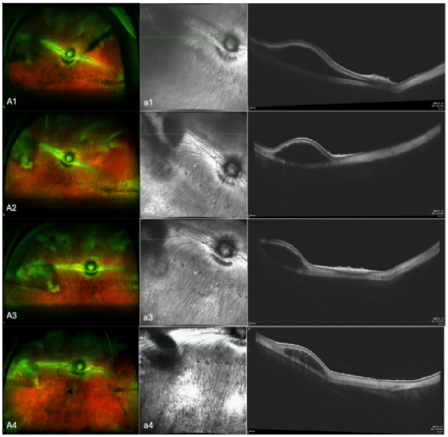 Four rows of eye scans show different imaging methods. Each row has three images: a color scan, a close-up grayscale scan, and an optical coherence tomography scan. Each set highlights variations in eye structure and retinal layers.