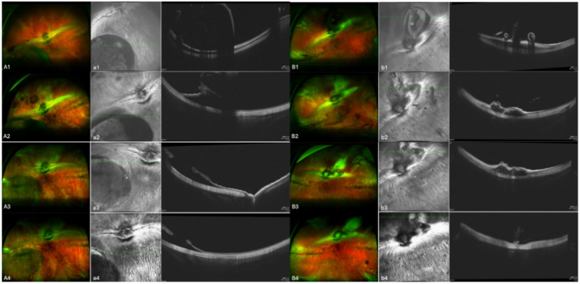 A grid of medical imaging scans showing various sections of an eye. Each row contains four colored images on the left and corresponding grayscale images on the right, labeled from A1 to A4 and B1 to B4. The colored images display green and red hues, possibly indicating areas of interest. The grayscale images emphasize structural details, likely using different imaging techniques for comprehensive analysis. The scans appear to compare different conditions or treatments in the eye structure.