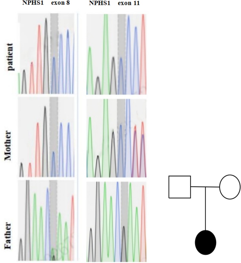 Genetic sequencing chromatograms for NPHS1 gene mutations in exon 8 and exon 11 for a patient, mother, and father. The chromatograms show varying peaks representing different nucleotides. On the right is a pedigree chart with a square for the father, a circle for the mother, and a filled circle for the patient, indicating the patient is affected.
