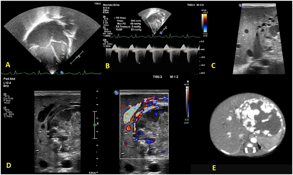 Composite figure showing echocardiographic images of dilated right heart chambers (a) and tricuspid regurgitation (b), liver ultrasound with a left lobe mass (c) and ncreased vascularity on Doppler (d), and confirmatory contrast-enhanced CT scan of the liver (e).