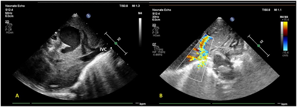 Subcostal and liver ultrasound views showing a saccular hypo-echoic area draining into the IVC (a) and Doppler image with an anomalous turbulent-flow vessel (b).