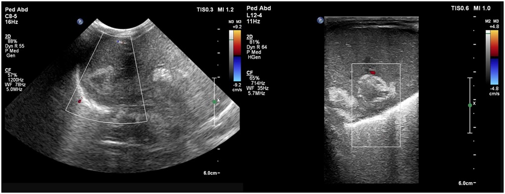 Liver ultrasound showing multiple well-defined heterogeneous hypoechoic lesions with echogenic walls and septations; Doppler without internal or peripheral flow.