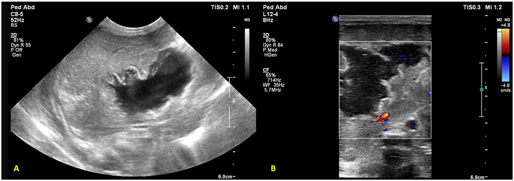 Ultrasound showing a thick-walled hyperechoic liver lesion (a) with cystic center and mobile echoes (b), consistent with an abscess.