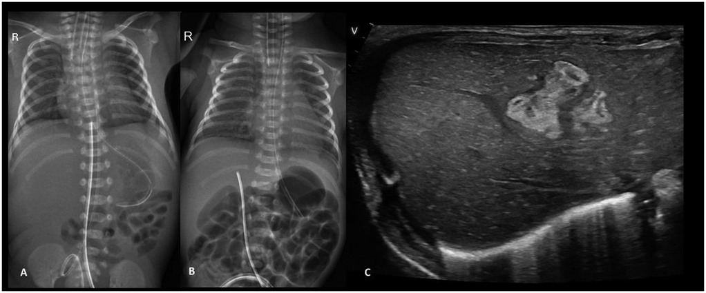 Radiographs showing UVC tip at diaphragm level (a) and later migration to T12, likely hepatic (b), with liver ultrasound revealing a heteroechoic right lobe mass (c).