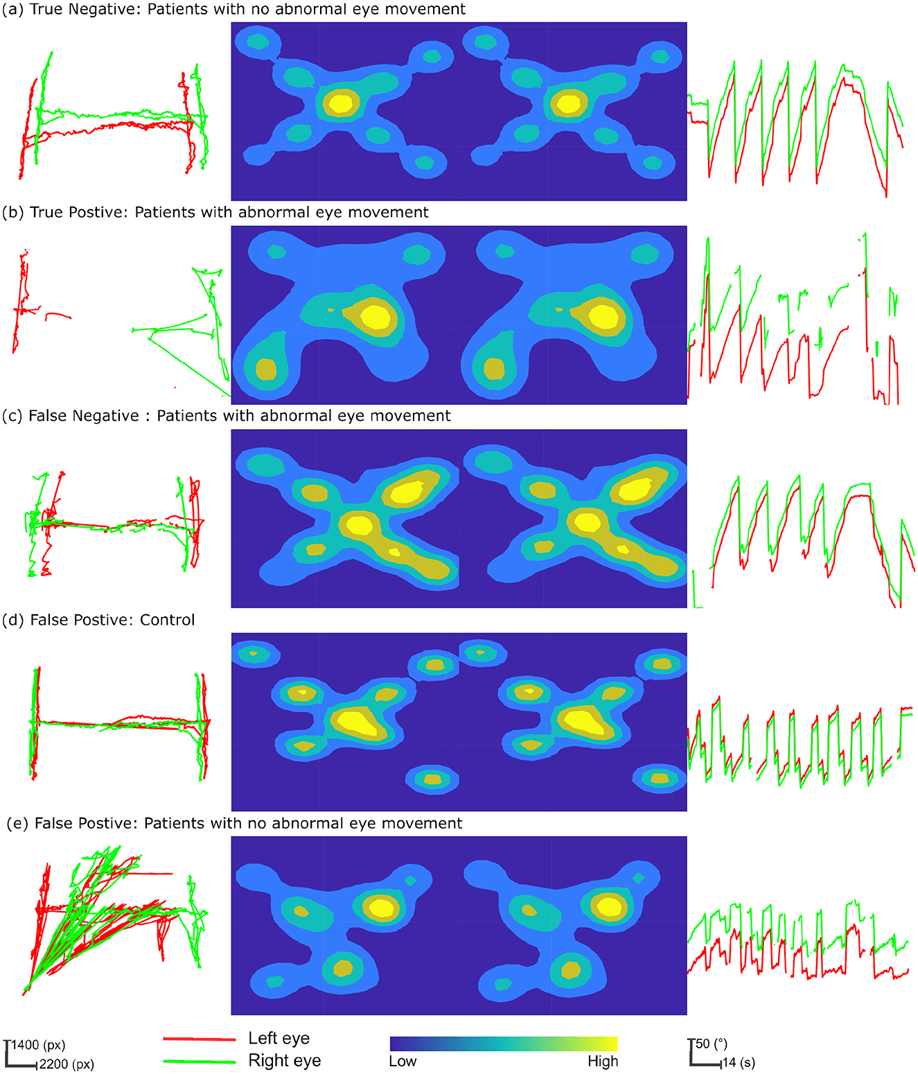Five panels compare eye movement data using trajectory plots and heat maps. (a) True Negative: Green and red lines show no abnormal movement in trajectory and heat maps with regular waveforms. (b) True Positive: Displays abnormal patterns in both trajectory and heat maps with irregular waveforms. (c) False Negative: Shows typical movements in trajectory but anomalous heat map patterns and waveforms. (d) False Positive: Control data has standard trajectory and heat maps with consistent waveforms. (e) False Positive: Similar to (d), standard trajectories but more irregular heat map patterns, with less consistent waveforms. Green and red lines represent right and left eye movements, respectively.