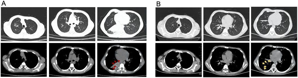 CT scan images comparing pre-treatment (A) and post-treatment (B) lung sections in the same patient. Each set displays three horizontal slices. The bottom row highlights areas with arrows: red in A and yellow in B, indicating points of interest or abnormality.