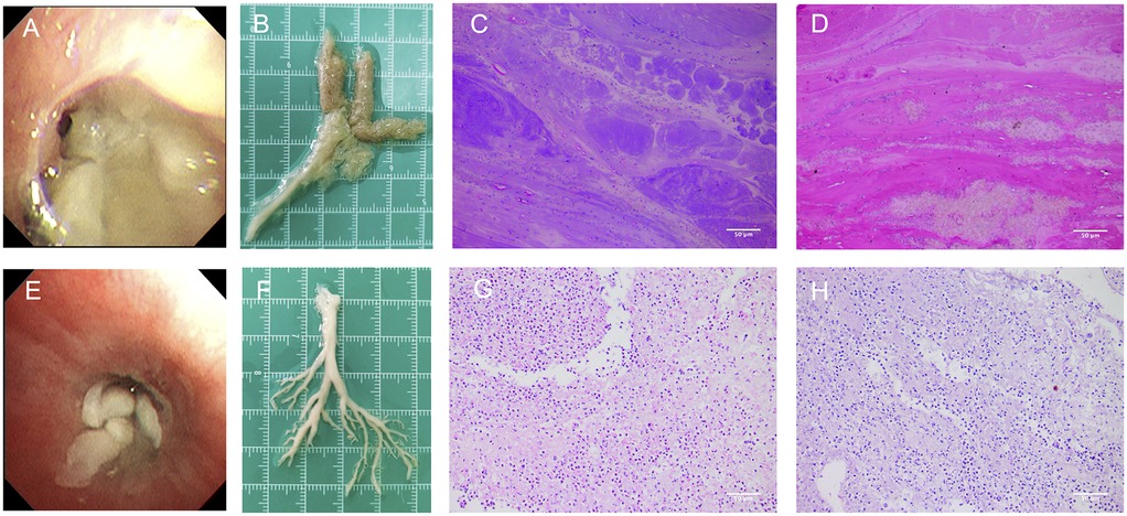 Composite image showing various medical and biological visuals. A and E depict endoscopic views of airway blockages. B and F display branched structures on a gridded mat, indicating their size. C, D, G, and H are micrographs with pink and purple staining, illustrating different tissue structures. Each section is labeled with letters for reference.