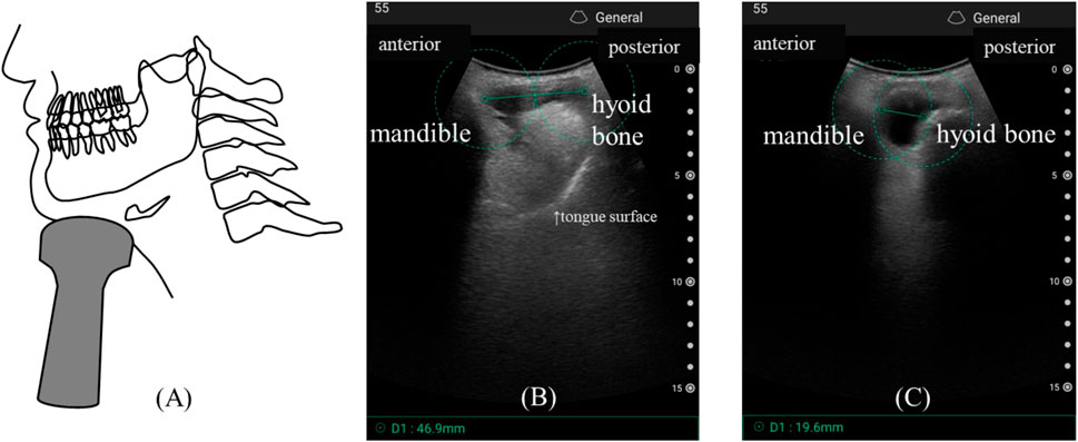 Diagram showing a side view of a human head and neck with dental structure, mandible, and spine labeled (A). Two ultrasound images detail the areas between the mandible and hyoid bone, labeled anterior and posterior, showing tongue surface and bone structures (B and C).