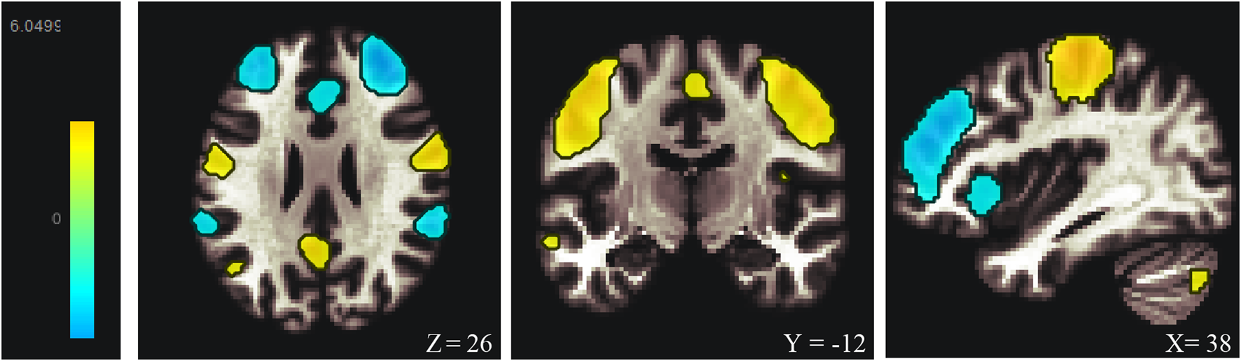 Three neuroimaging slices show brain areas in different orientations with color overlays. Each slice highlights regions in blue and yellow, indicating different activity levels. A color scale bar on the left represents activity intensity from yellow to blue. Positions are labeled as Z equals twenty-six, Y equals negative twelve, and X equals thirty-eight.