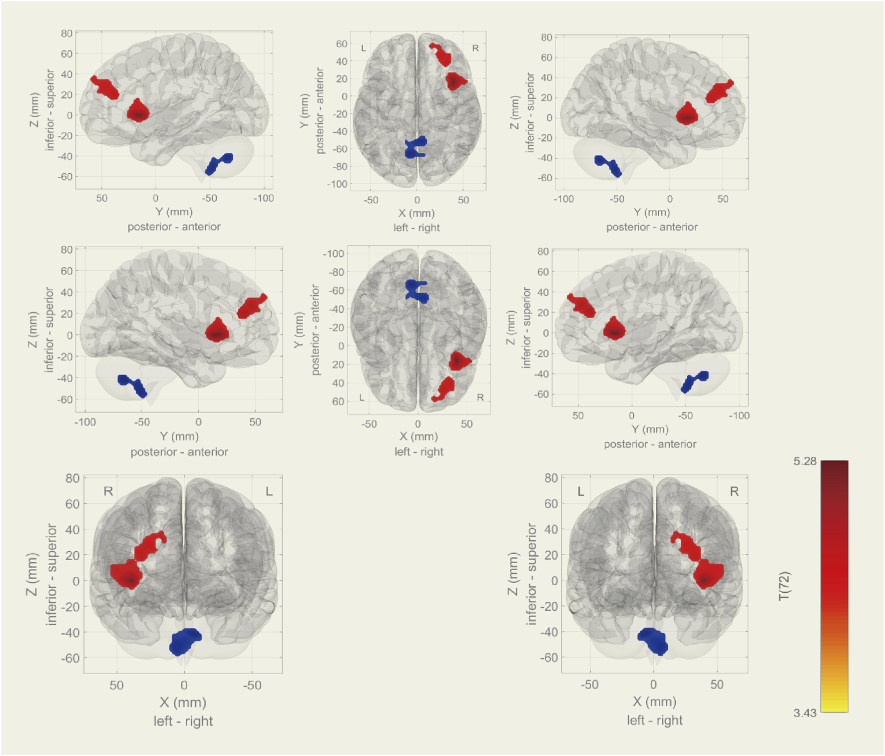 Brain diagrams with red and blue highlighted areas in different views, including lateral, posterior, and superior perspectives. Axes show X, Y, Z coordinates in millimeters. A color bar on the right indicates T values from 3.43 to 5.28.