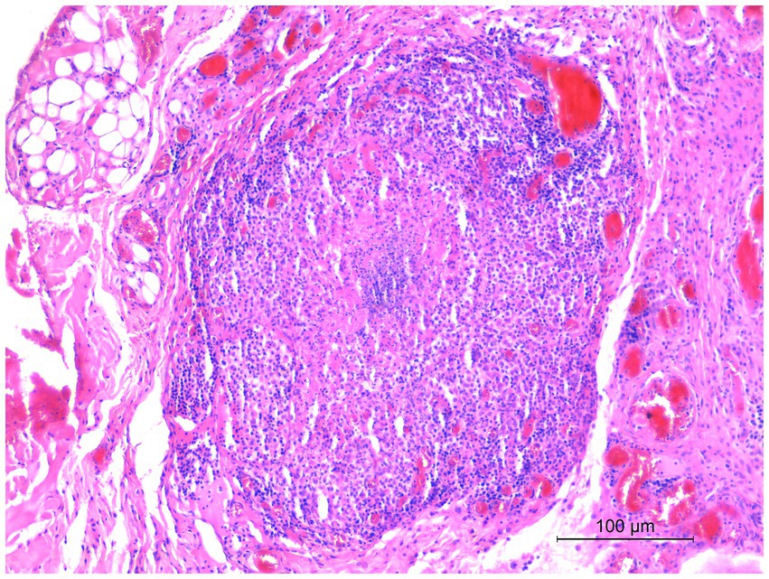 Histological image showing a section of human tissue stained with hematoxylin and eosin. The image depicts lymphoid infiltrates with dense clusters of dark blue nuclei, indicating lymphocytes, surrounded by pink-stained connective tissue. The scale bar at the bottom indicates a length of 100 micrometers.