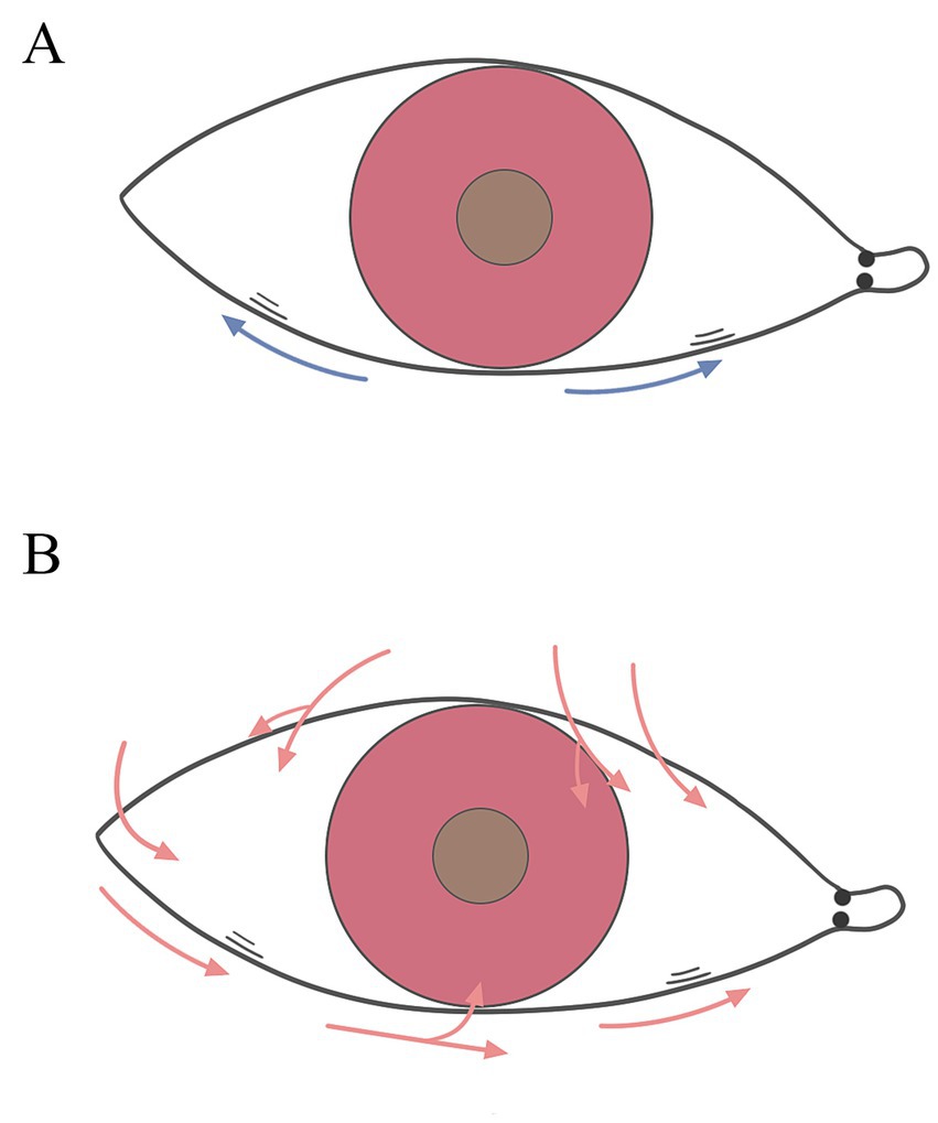 Figure show sole of nasal and temporal side LIPCOFs for the tear meniscus. A.The blue arrows represent the capillary effect, B.The red arrows represent the direction of tear flow.