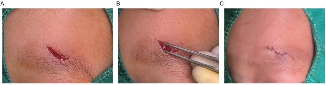 Three-panel image showing the stages of wound treatment. Panel A: A fresh, open laceration on the skin. Panel B: Surgical tweezers are used to handle the wound edges. Panel C: The wound is closed with sutures.