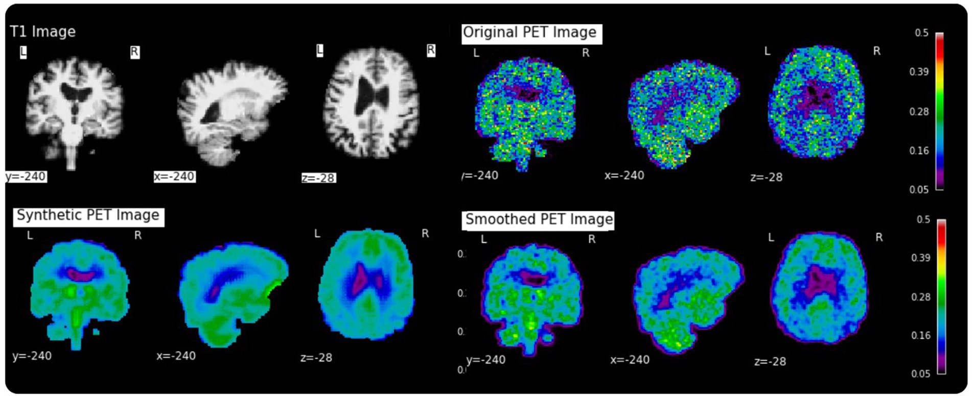Twelve-panel neuroscientific image showing T1, original PET, synthetic PET, and smoothed PET brain scans. Each row has three views: coronal, sagittal, and axial. Color scales indicate varying intensity levels.