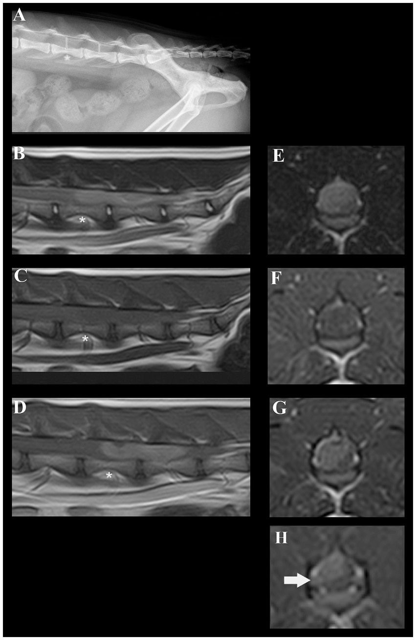 A composite image showing spinal radiographs and MRIs. Image A displays a lateral view X-ray of a spine with an asterisk marking a point of interest. Images B, C, and D are sagittal MRI scans of the spine, each with an asterisk highlighting a specific area. Images E, F, and G are axial MRI views, while image H showcases an axial MRI with an arrow pointing to a location of interest.