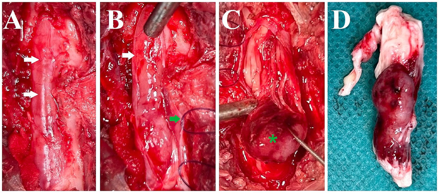 Four-panel medical image showing a surgical procedure. Panel A shows an exposed area with two arrows pointing to it. Panel B features a similar view with arrows indicating different sections. Panel C displays surgical tools interacting with tissue; an asterisk marks a point of interest. Panel D presents an excised tissue mass on a blue background.