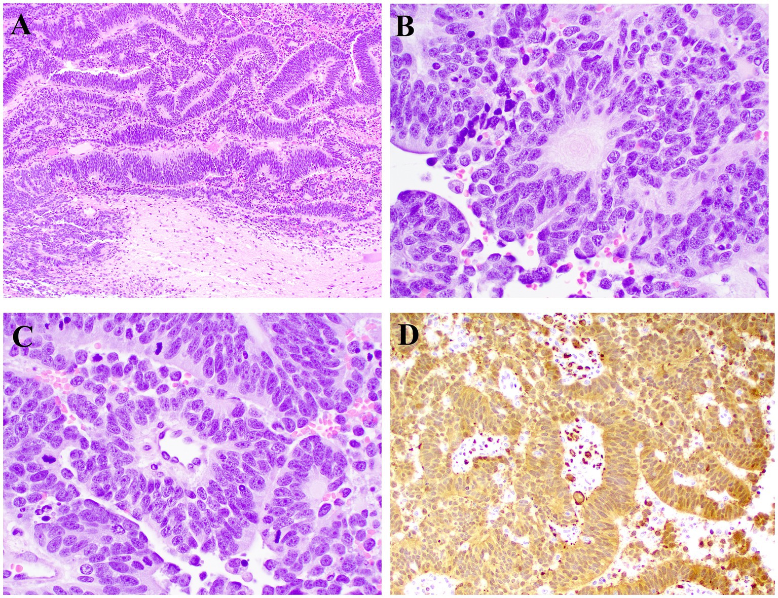 The figure shows microscopic photographs of histology. Neoplastic cells of the spinal embryonal tumor in various arrangements are shown in the panels.