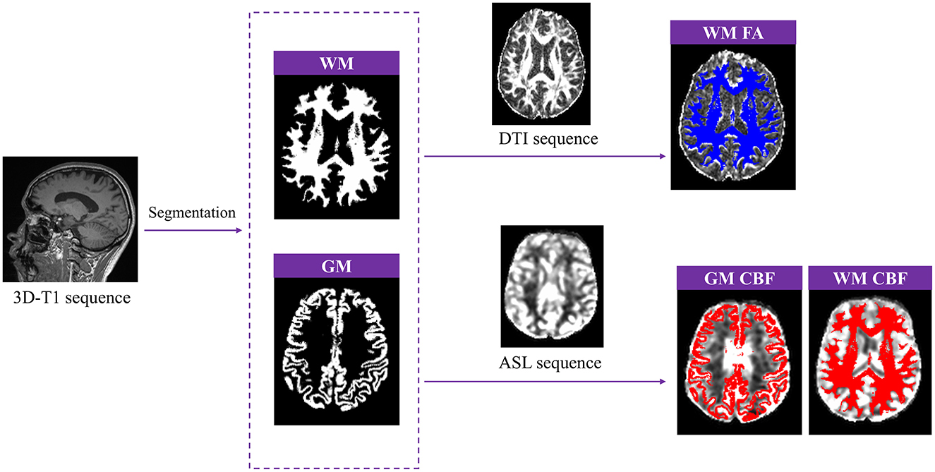 Flowchart depicting brain imaging sequences and segmentations. A 3D-T1 sequence undergoes segmentation, resulting in white matter (WM) and gray matter (GM) images. The WM image connects to a DTI sequence and results in WM FA and WM CBF images, showing fiber tracts and blood flow with blue and red color coding. The GM image connects to an ASL sequence, producing GM CBF, highlighting blood flow in red.
