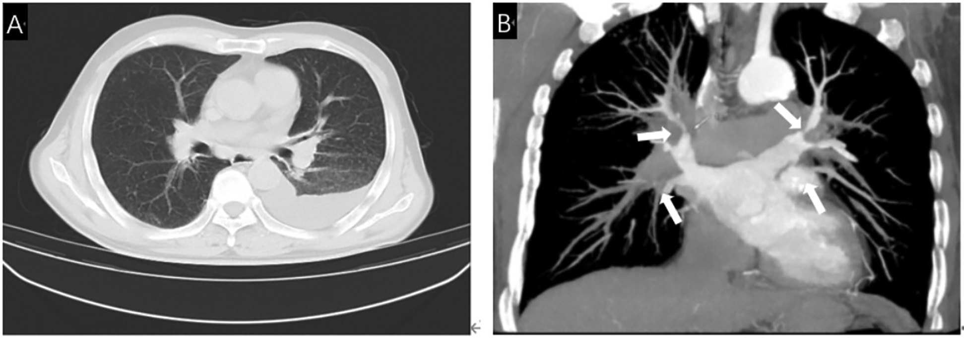 CT scan with two panels: Panel A shows a cross-sectional view of the chest with clear lung fields and well-defined heart silhouette. Panel B shows a coronal view highlighting abnormalities in the lung's bronchial regions, marked by arrows.