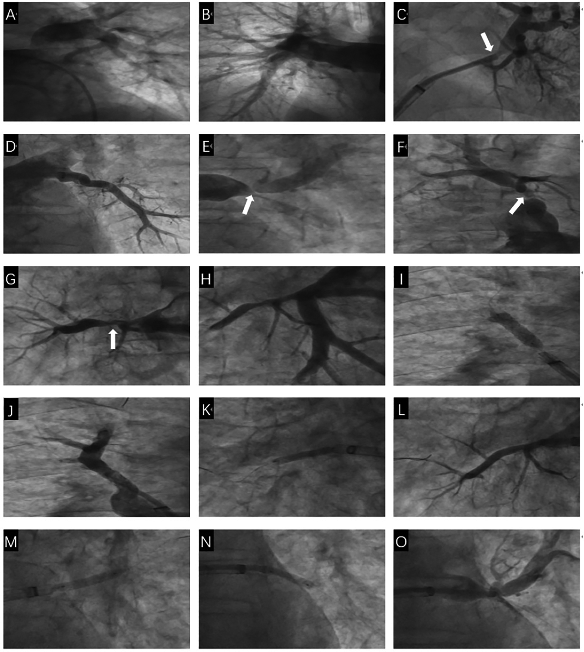 A series of fourteen contrast-enhanced angiographic images labeled A to O, showcasing various vascular structures. Arrows indicate significant areas of interest or potential abnormalities in images C, E, F, and G. Each panel displays different angles and sections, emphasizing the intricacies of the vessels. The images highlight the diagnostic investigation of potential vascular issues.