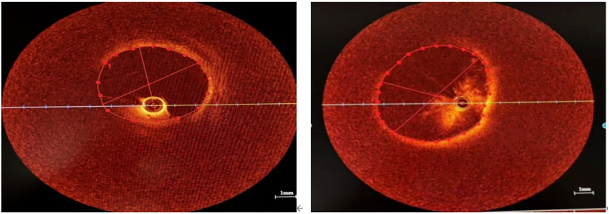 Two circular diagnostic images display detailed cross-sections of a tubular structure. Both images use red and orange tones, highlighting inner formations with radial lines and measurements. A scale indicates a length of one millimeter.