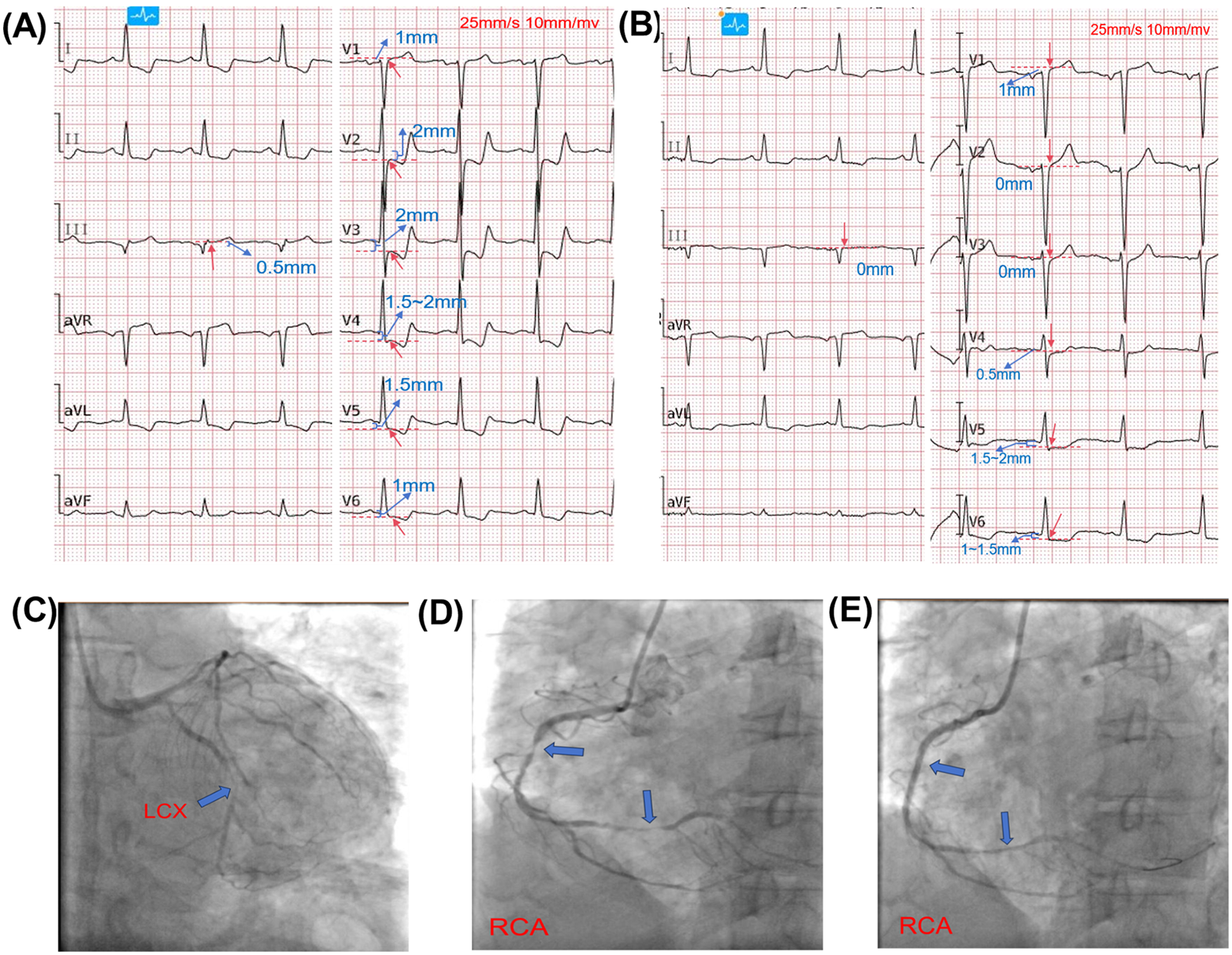 Panel A shows a 12-lead electrocardiogram with ST-segment depression in leads V2 to V6 and mild elevation in lead III. Panel B shows a follow-up electrocardiogram with reduced magnitude of ST-segment deviation and partial normalization, indicating clinical improvement. Panel C shows the left circumflex artery (LCX) with unobstructed flow. Panels D and E show the right coronary artery (RCA) with multiple arrows indicating areas of stenosis or occlusion. Together, the images illustrate ECG changes and angiographic findings consistent with evolving myocardial infarction and coronary artery involvement.