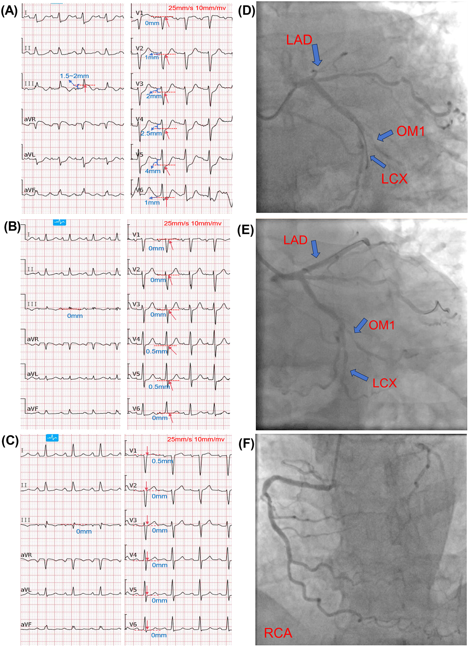 Panels A to C display sequential 12-lead electrocardiograms. Panel A shows significant ST-segment depression in leads V2 to V6 and pronounced elevation in lead III. Panels B and C demonstrate progressive resolution of the ST-segment deviations, suggesting successful reperfusion. Panels D and E are coronary angiograms of the left coronary system, with arrows highlighting the LAD, OM1, and LCX branches; Panel D shows arterial narrowing, while Panel E shows restored patency post-intervention. Panel F presents a right coronary artery (RCA) angiogram with unobstructed flow. The images collectively depict diagnosis, intervention, and recovery in coronary artery disease.