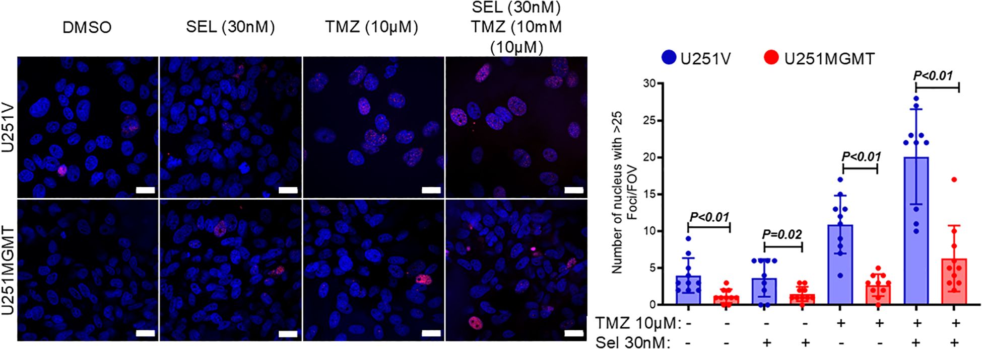 Fluorescent microscopy images and a bar chart illustrate the effects of DMSO, SEL, TMZ, and their combinations on U251V and U251MGMT cell lines. Cells stained in blue, with red indicating specific foci. The chart compares the number of nuclei with over twenty-five foci per field of view, showing significant differences with P values less than 0.01 and 0.02. The blue bars represent U251V, and the red bars represent U251MGMT.