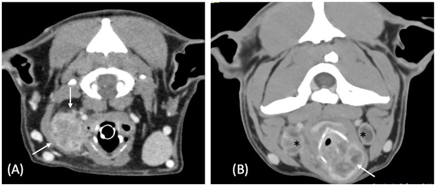 CT scan images in axial view depict different anatomical structures of the neck. Image (A) shows arrows pointing to specific areas of interest, possibly indicating abnormalities. Image (B) displays similar anatomical features with additional markers, such as an asterisk, highlighting regions of interest for medical examination or diagnosis.