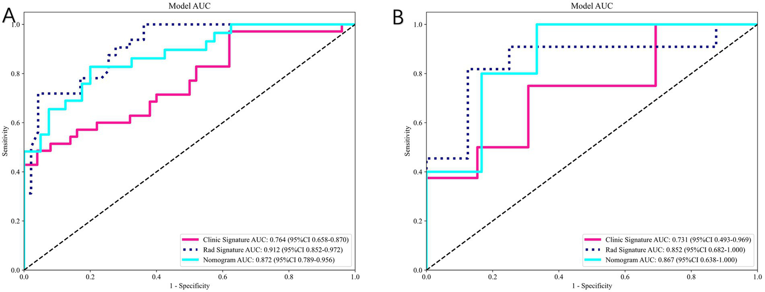 Two ROC curve graphs labeled A and B display the performance of three models: Clinic Signature (pink), Rad Signature (blue dotted), and Nomogram (cyan). Panel A shows Clinic Signature with an AUC of 0.764, Rad Signature with 0.912, and Nomogram with 0.872. Panel B shows Clinic Signature with an AUC of 0.731, Rad Signature with 0.852, and Nomogram with 0.867. Axes are sensitivity versus 1-specificity, with a diagonal line indicating random chance.