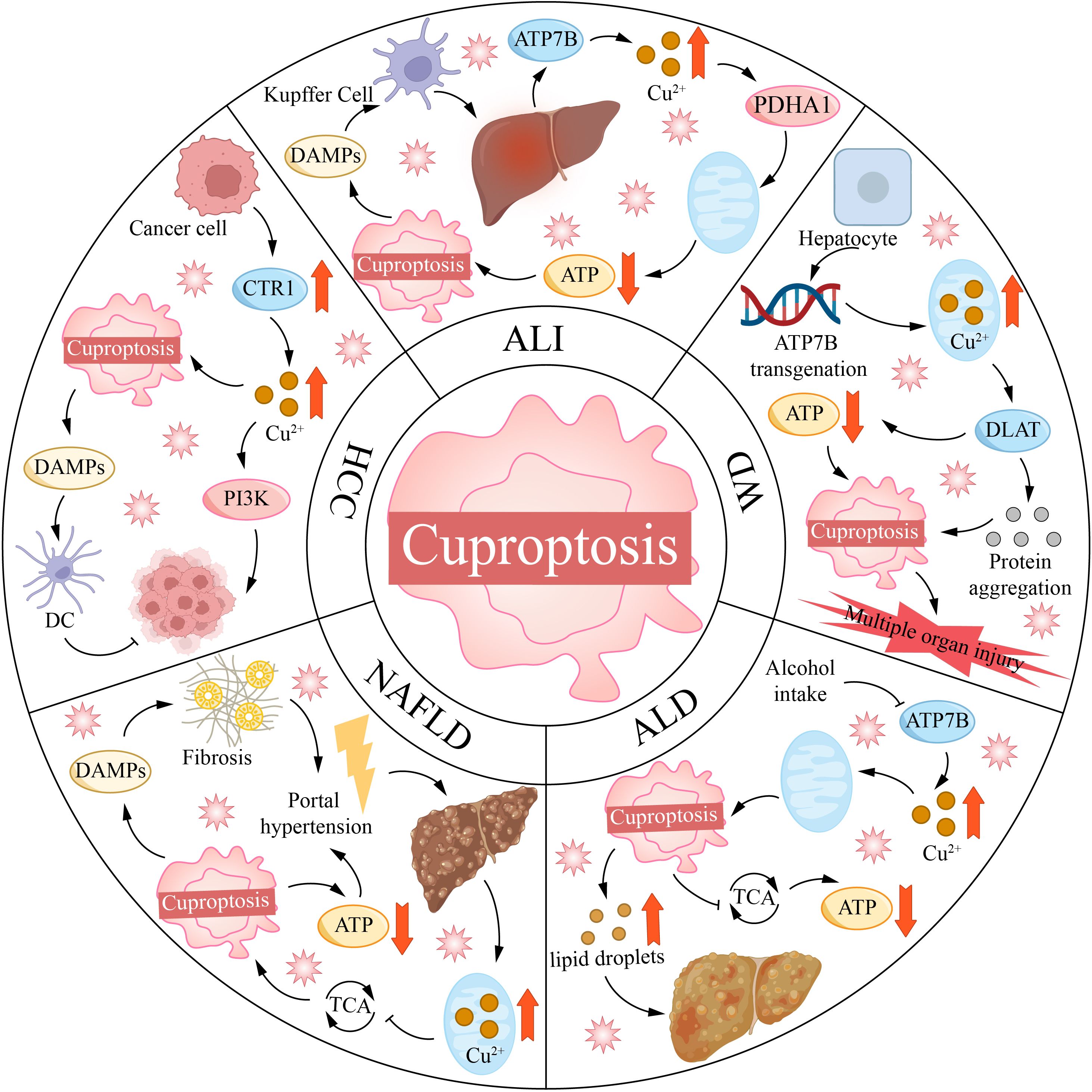 Infographic illustrating the process of cuproptosis in different liver conditions: ALI, WD, ALD, NAFLD, and HCC. Diagram shows interactions involving Kupffer cells, cancer cells, hepatocytes, and components like ATP7B, copper ions, and ATP. Arrows indicate metabolic pathways, protein aggregation, and cellular effects leading to multiple organ injury.