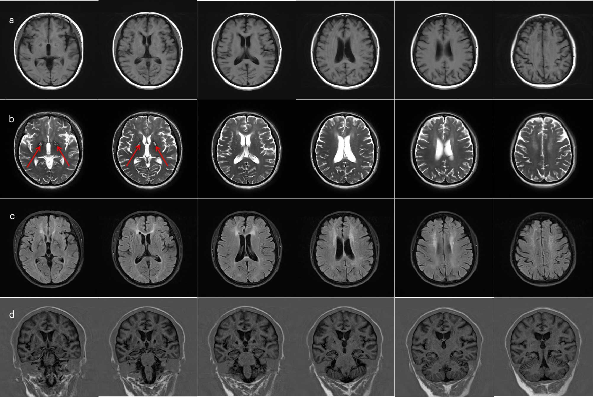 MRI brain scans in four rows labeled a, b, c, and d. Row (a) shows T1-weighted axial images highlighting brain structure. Row (b) displays T2-weighted axial images with red arrows indicating the bilateral basal ganglia areas. Row (c) features FLAIR axial images showing different contrast. Row (d) contains coronal T1-weighted images presenting another view of brain anatomy.