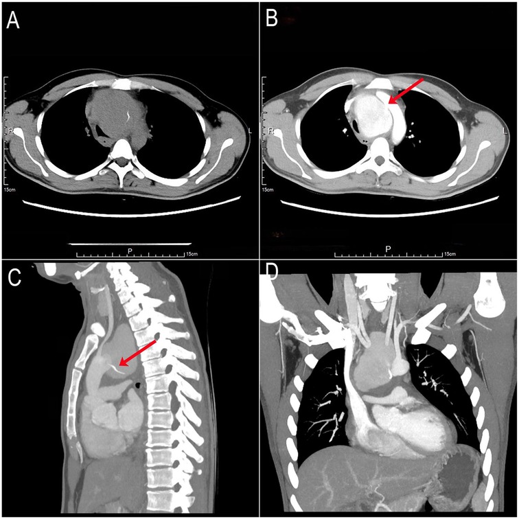 CT scans in four panels. Panel A: axial view of the thorax without contrast. Panel B: axial view with contrast, red arrow indicating a mass. Panel C: sagittal view with contrast, red arrow pointing to the mass near the spine. Panel D: coronal view showing the chest cavity with highlighted structures.