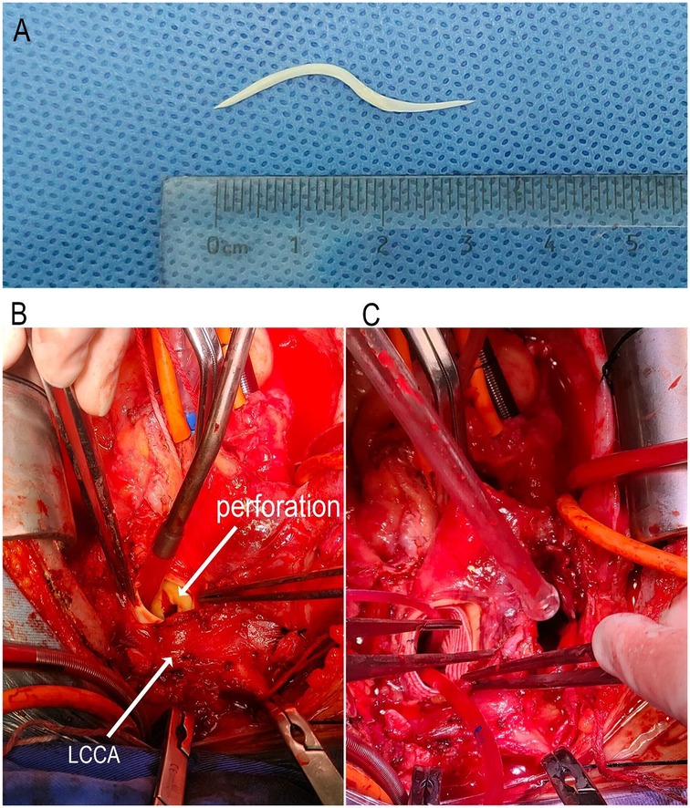 Panel A shows a small curved foreign object placed next to a ruler for scale, measuring approximately 4.5 centimeters. Panels B and C depict surgical images of an open chest cavity with labeled areas indicating a perforation and the left common carotid artery (LCCA) amidst surgical instruments.