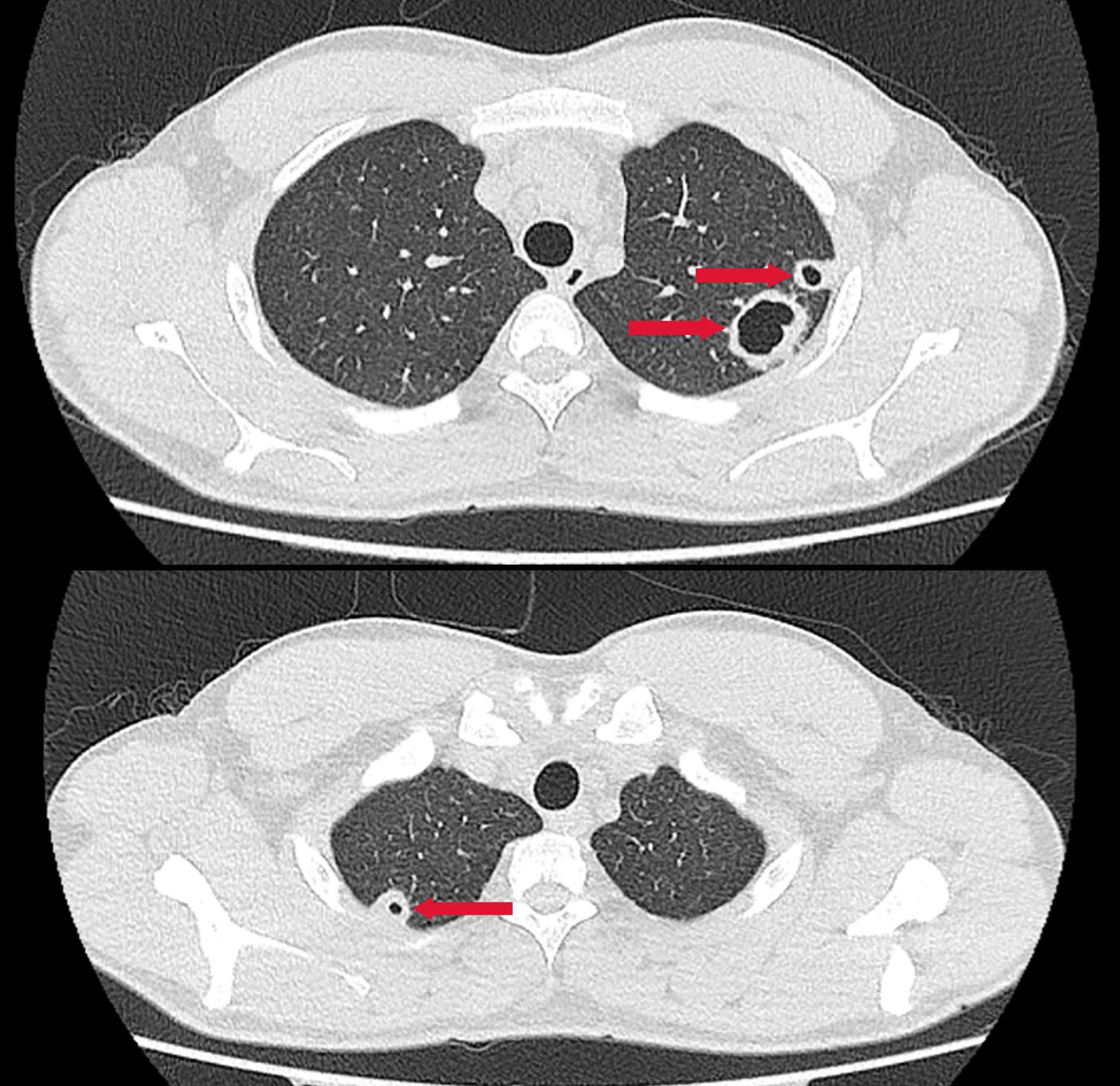 CT scan showing two axial views of the chest. The top image highlights two areas in the right lung with red arrows pointing to a circular lesion and a larger irregular mass. The bottom image features a single red arrow pointing to a small nodule in the left lung near the rib wall. Bone structures and lung fields are visible.