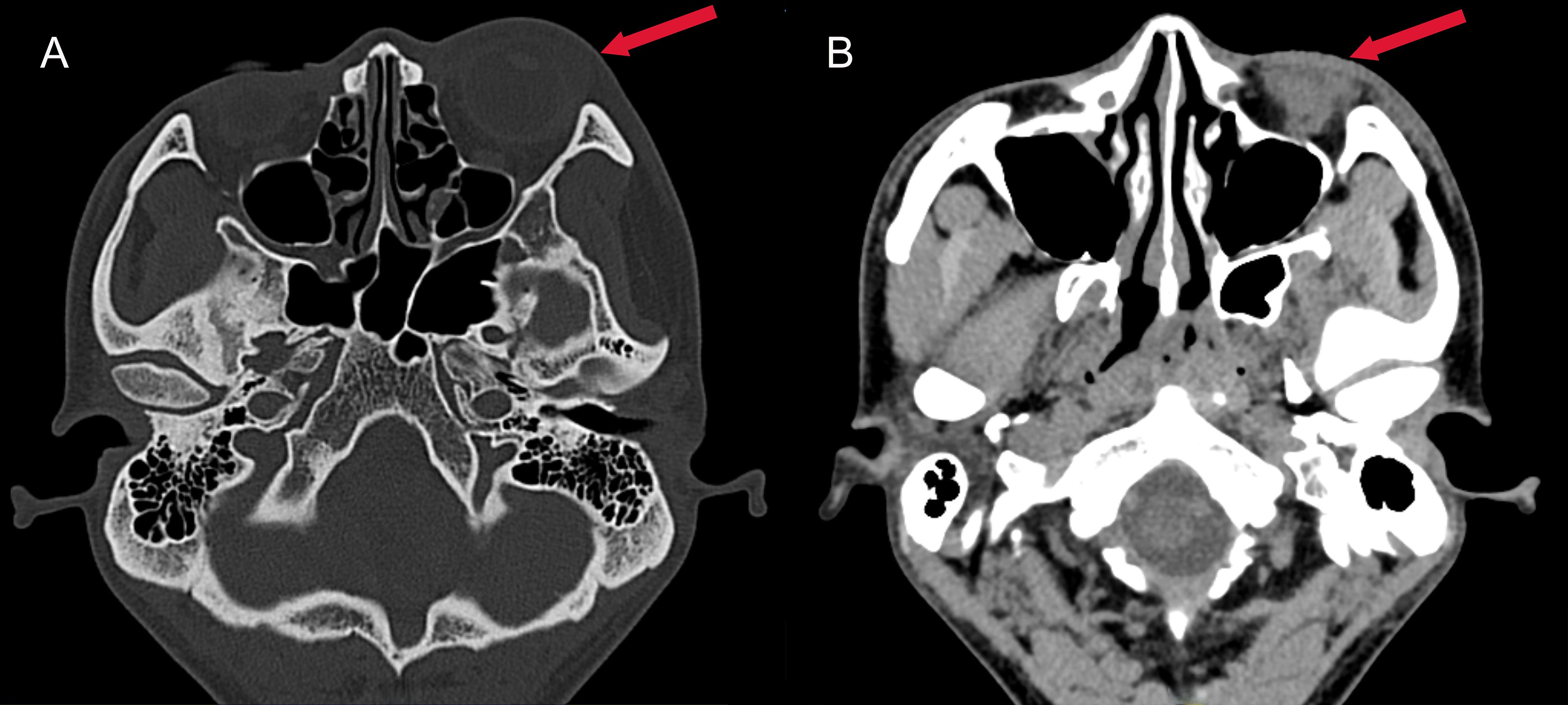 CT scan images labeled A and B showing transverse views of a skull. Both images highlight an area with an arrow indicating a region of interest on the right side of the forehead. Image A is a bone window view, and image B is a soft tissue window view.