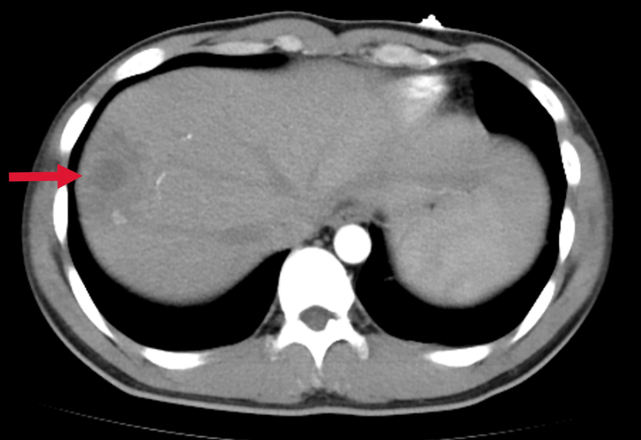 CT scan of an abdominal cross-section highlighting a liver lesion. A red arrow points to a circular area on the left side of the liver, indicating an abnormality. Surrounding organs and structures are visible in gray tones.