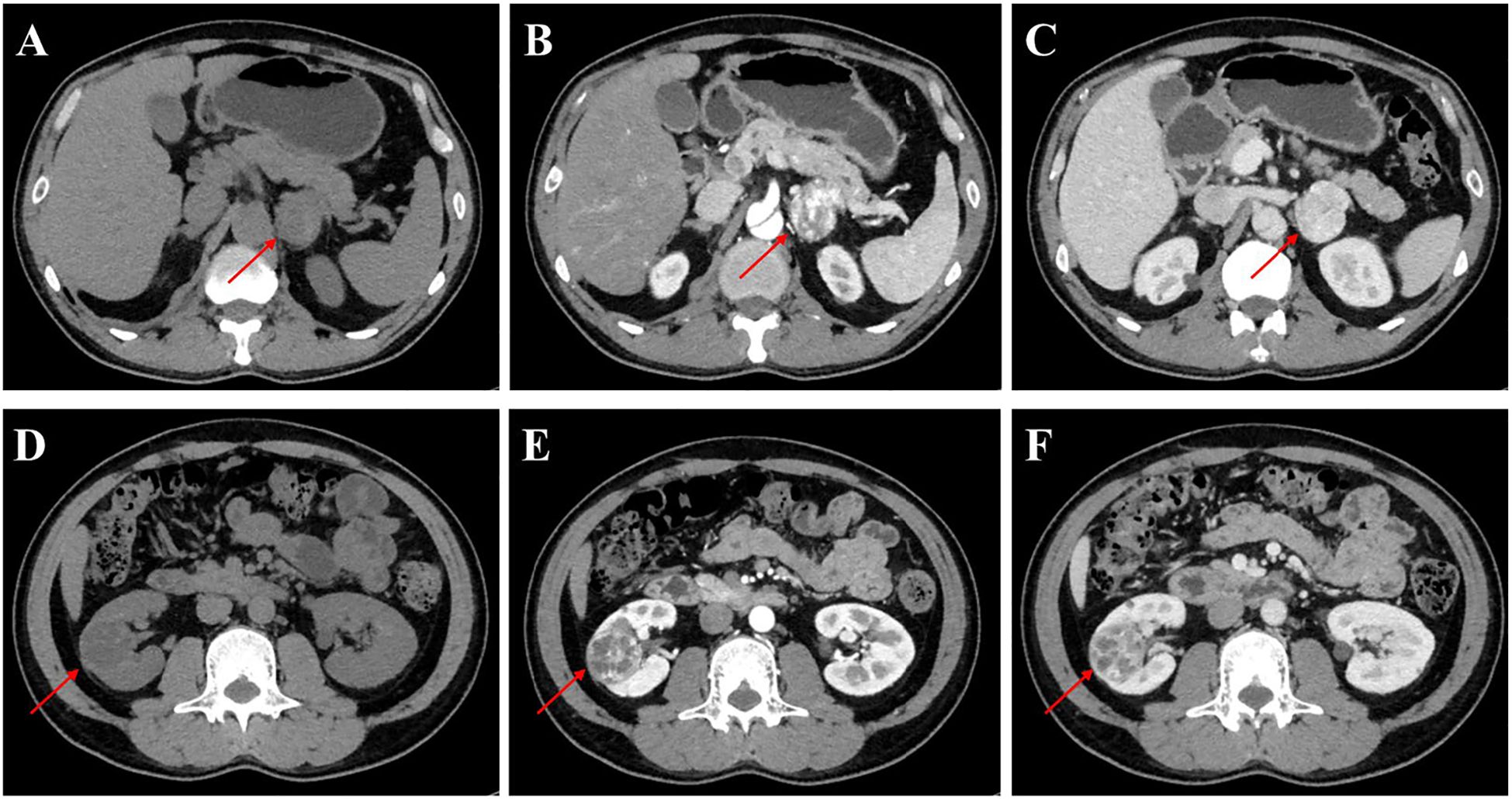 Six-panel CT scan images labeled A to F show different abdominal sections. Each panel has a red arrow pointing to specific areas, indicating points of interest. The images include various organs and tissues in cross-section.