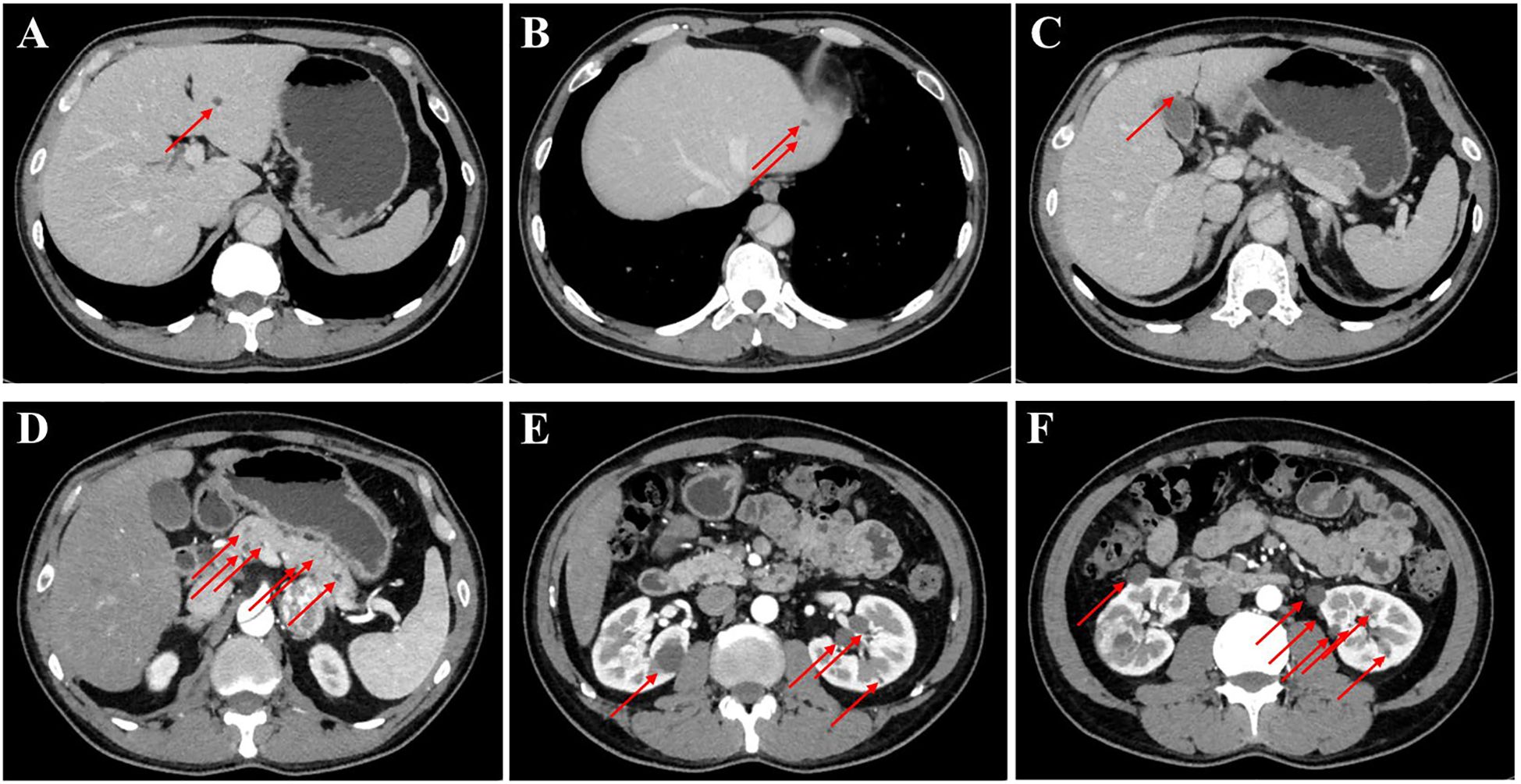 CT scans show six abdominal images labeled A to F. Arrows highlight specific anatomical features: A shows an arrow in the liver, B shows arrows indicating changes near the liver, C highlights an area near the liver, D shows multiple arrows near the pancreas, E indicates changes around the kidneys, and F highlights multiple areas in the abdomen.