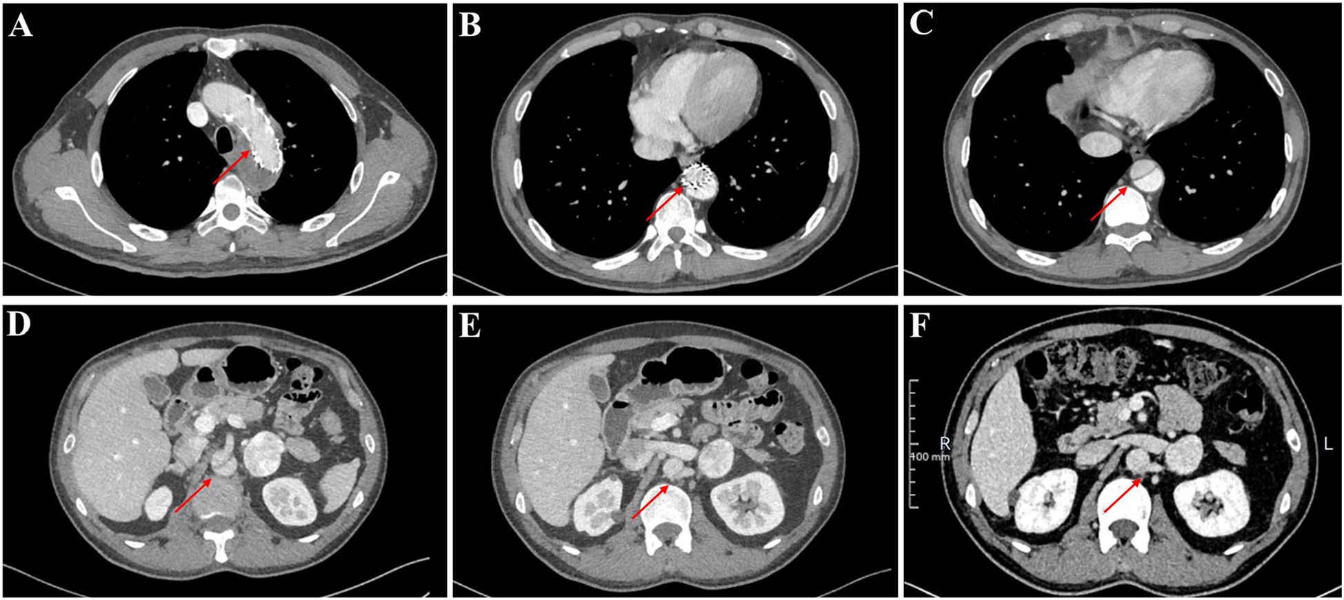 Six-panel CT scan images labeled A to F, each showing cross-sectional views of the thoracic and abdominal regions. Red arrows highlight specific areas of interest in each scan, indicating variations in tissue or possible abnormalities.
