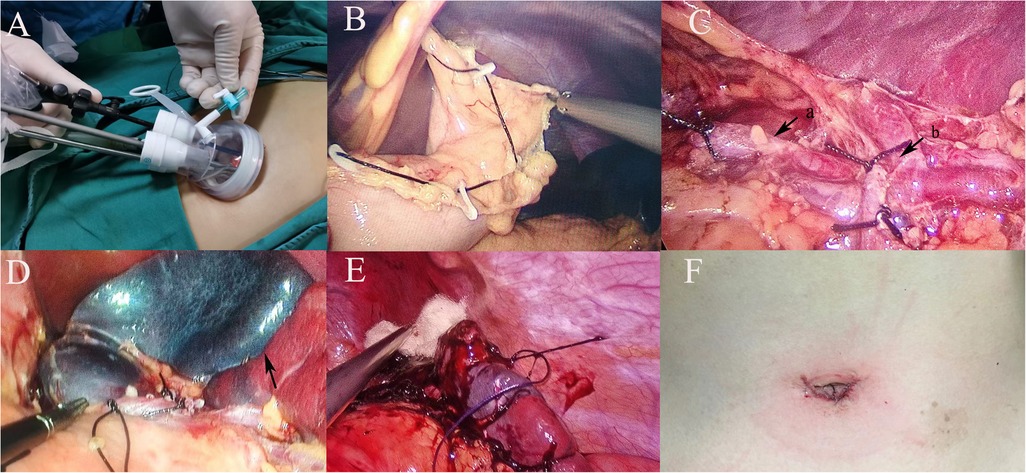 A series of six labeled images showing a surgical procedure. A: Instruments inserted into a patient’s abdomen. B: Close-up of internal organs with sutures. C: Internal view highlighting specific areas. D: Surgical tools near a stitched area. E: Sutured incision within an organ. F: Healed incision on skin.