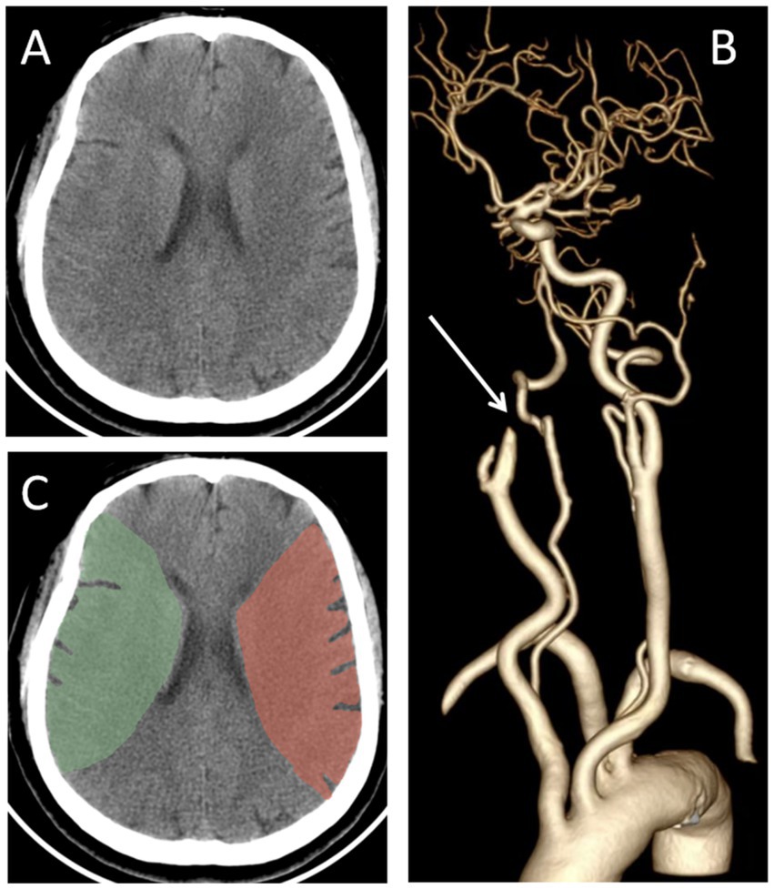 CT scan images of the brain and a 3D reconstruction of cerebral arteries. Panel A shows a normal axial brain CT. Panel B is a 3D rendering of cerebral arteries, with an arrow indicating a specific vessel. Panel C highlights brain regions in green and red, likely indicating areas of interest or abnormality.