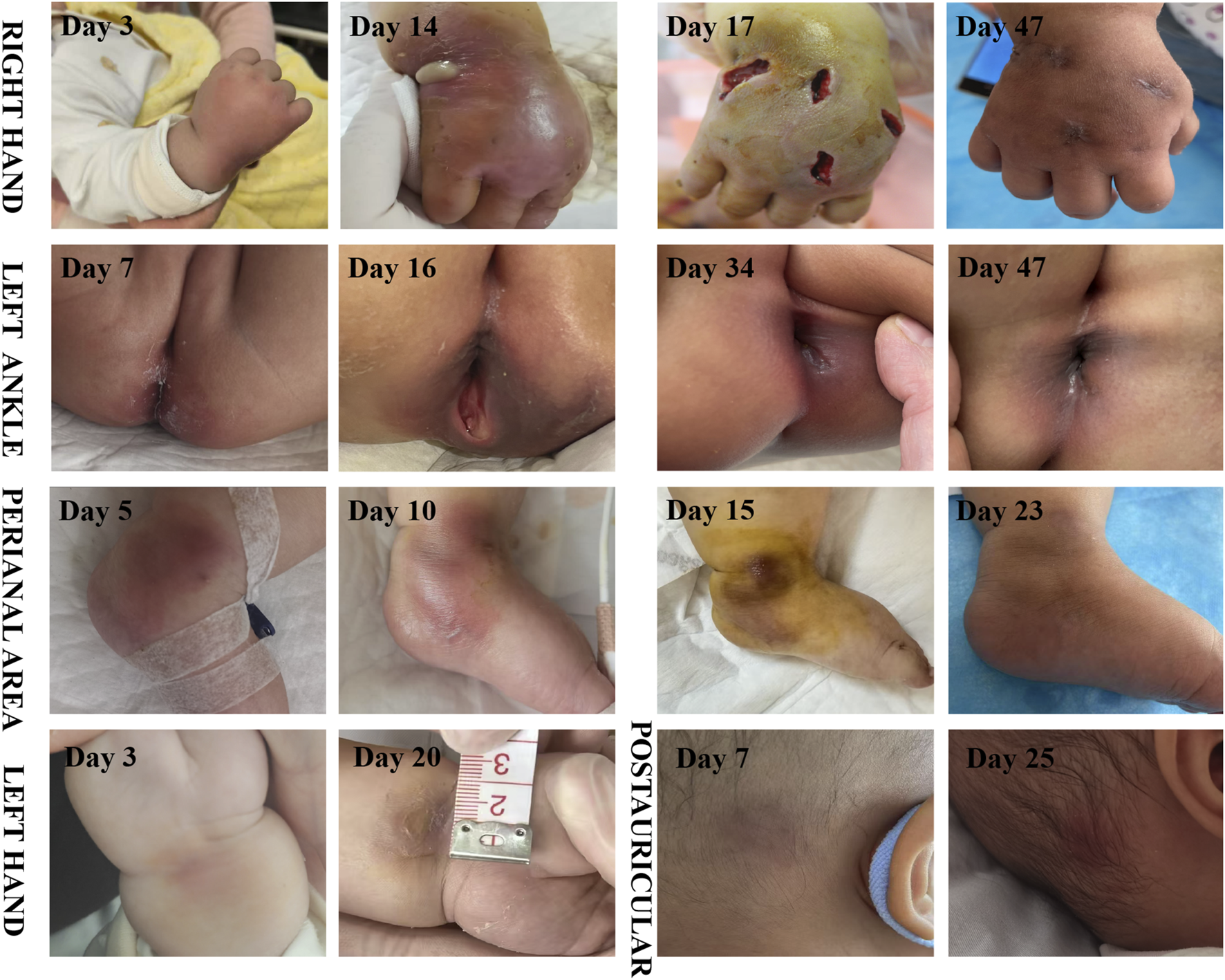 A series of images showing the progression of skin lesions over time in different body parts of an infant: right hand, left ankle, perianal area, left hand, and postauricular region. Each body part displays changes on various days, illustrating the healing process. The right hand shows a swollen lesion on day 14 and healing scars by day 47. The left ankle shows skin irritation on day 7 and improvement by day 47. The perianal area shows inflamed skin on day 5 and nearly healed by day 23. The left hand shows slight redness on day 3 and fading by day 20. The postauricular region shows irritation on day 7 and improvement by day 25.