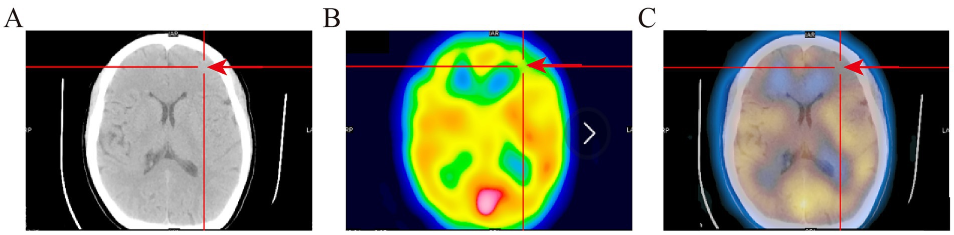 CT scan of a brain in three panels marked A, B, and C. Panel A shows a grayscale brain image with a red crosshair. Panel B displays a SPECT scan with colored regions indicating activity levels, also with a crosshair. Panel C combines both CT and PET scans, illustrating anatomical and functional aspects together, marked again with a red crosshair.