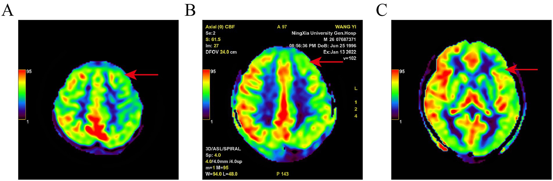 Three brain scan images labeled A, B, and C, each showing a color-coded heat map indicating cerebral blood flow. Red areas represent higher flow, transitioning through yellow, green, and blue for lower levels. Each image has a red arrow pointing to specific regions of interest.