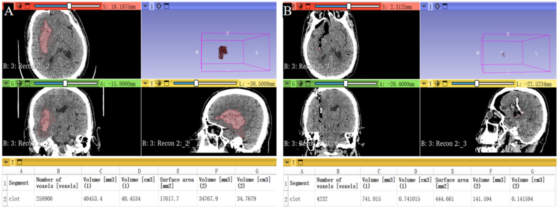 CT brain scan images labeled A and B show segmented areas highlighted in red, representing clots. Panels include cross-sectional views with measurement scales and sliders for orientation. Below each scan is a table detailing the number of voxels, volume, and surface area of the clots.
