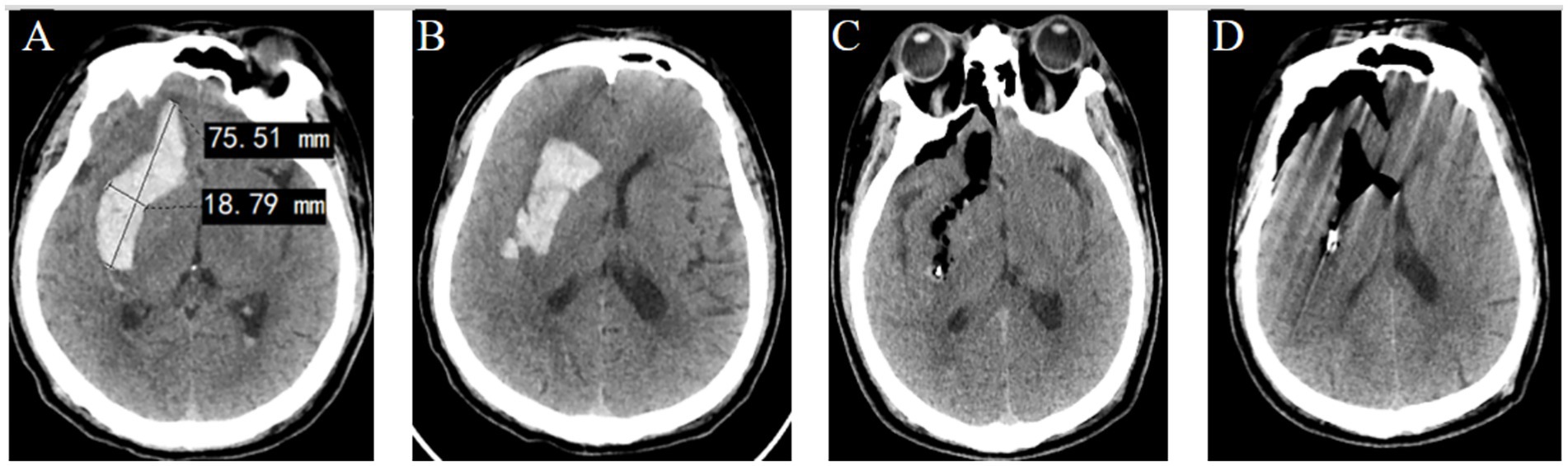 CT scans of a brain. Panel A shows a large intracranial hemorrhage with measurements of seventy-five point fifty-one millimeters and eighteen point seventy-nine millimeters. Panel B displays the hemorrhage without measurements. Panel C shows post-surgical intervention with reduced bleeding. Panel D presents further improvement in the hemorrhagic area.